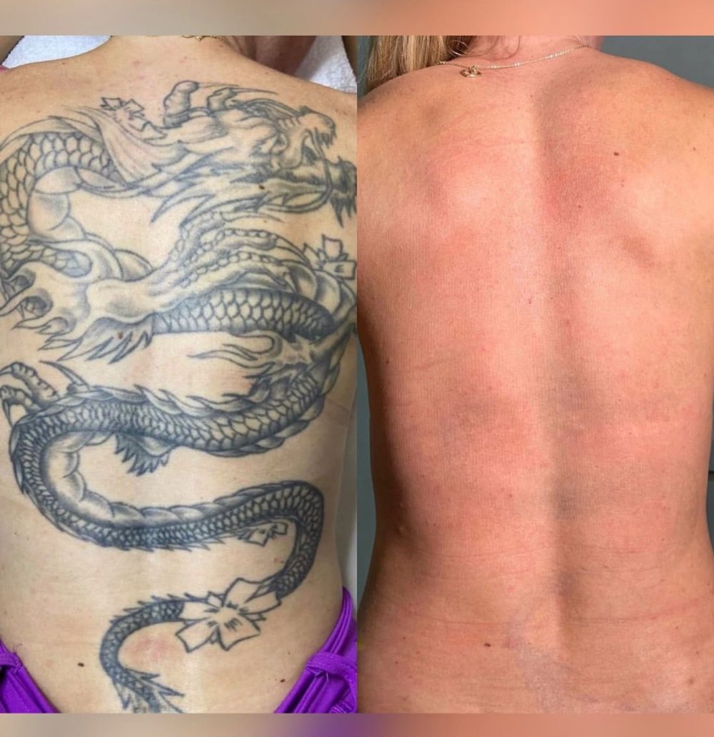 Remoção de tatuagem a laser nas costas: antes e depois, BTZ Med Novo Hamburgo